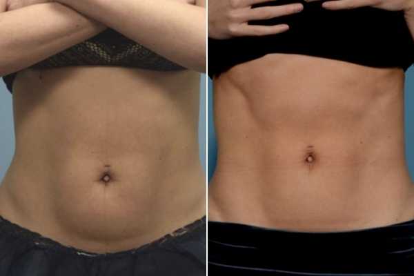 body sculpting FAQs Sutton in Ashfield