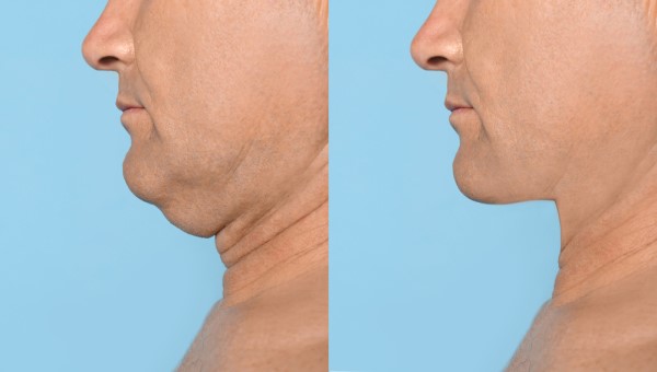 Which Non-Surgical Treatments Work Best for Jowls and Loose Skin Sutton in Ashfield?