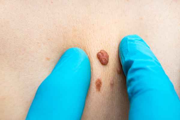 skin tag