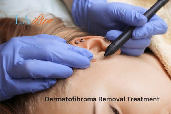 Dermatofibroma Removal Treatment Sutton in Ashfield