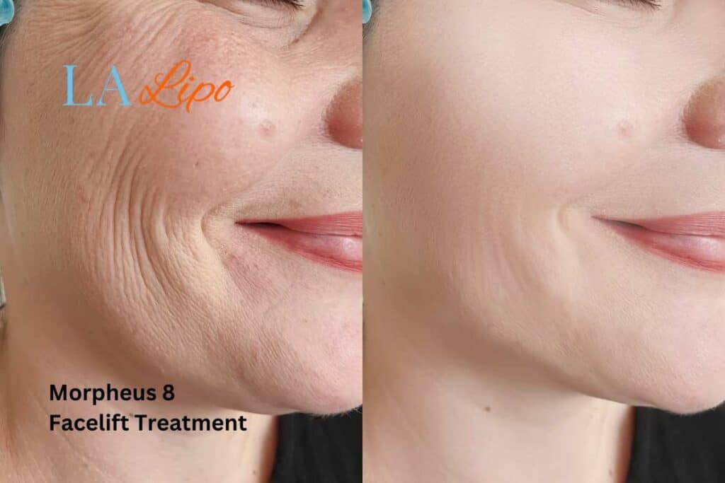 Morpheus8 Treatment Sutton in Ashfield for flawless skin! Call us today!