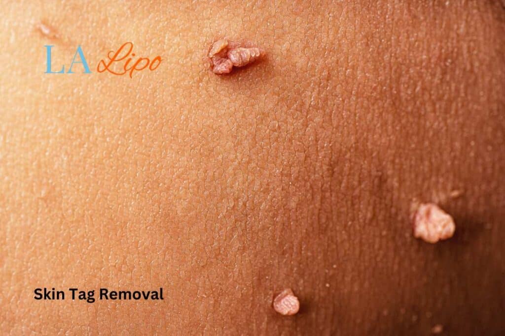 skin tag removal