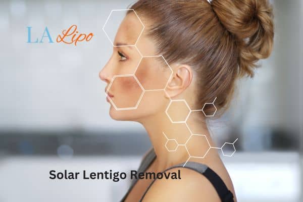 solar lentigo