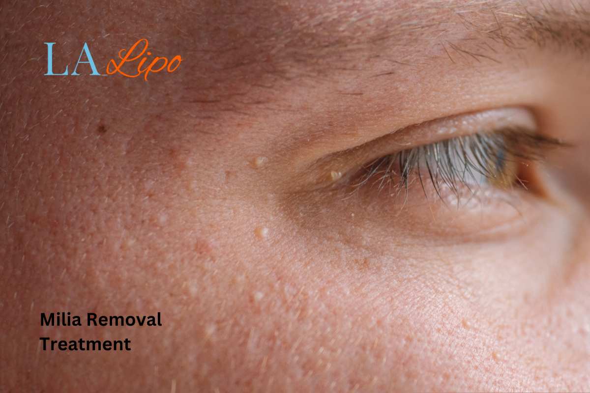 Cryopen Milia Removal: Is It the Easiest and Safest Option Sutton in Ashfield?
