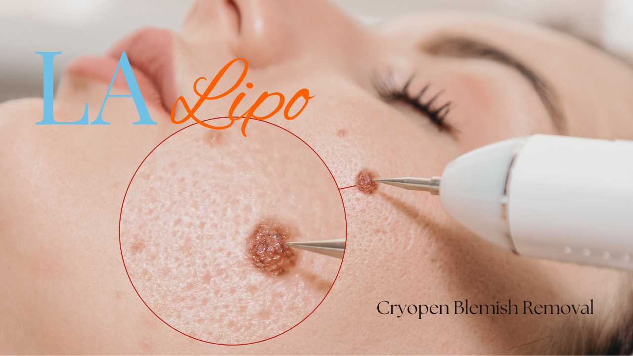 cryopen blemish removal Sutton in Ashfield Contact our team today!