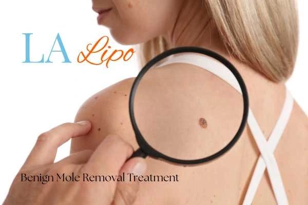 Woman having her inspection of blemish before mole removal Sutton in Ashfield