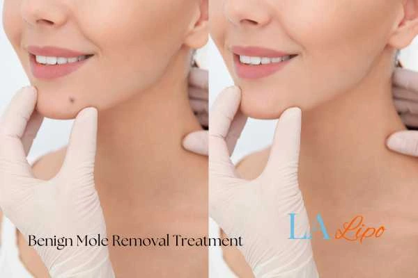 woman's before and after mole removal Sutton in Ashfield results