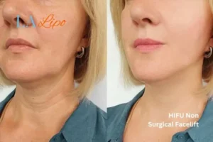 hi-fu for wrinkles Sutton in Ashfield before and after results