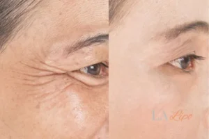 Before and after results of woman - HI-fu wrinkles reduction treatment Sutton in Ashfield