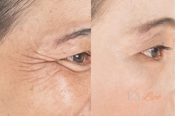 Before and after results of woman - HI-fu wrinkles reduction treatment Sutton in Ashfield