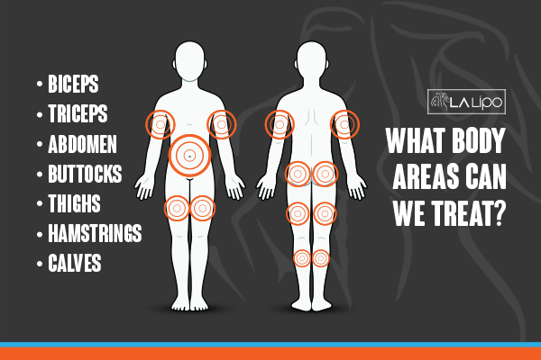 Graphic to show areas you can have LA-EMS Body Sculpting Sutton in Ashfield treatment.