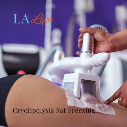 fat freezing - Cryolipolysis Sutton in Ashfield