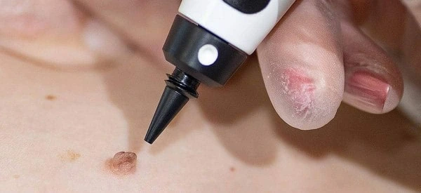 skin tag removal using cryopen Sutton in Ashfield