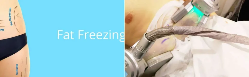Fat freezing Sutton in Ashfield on multiple areas of the body