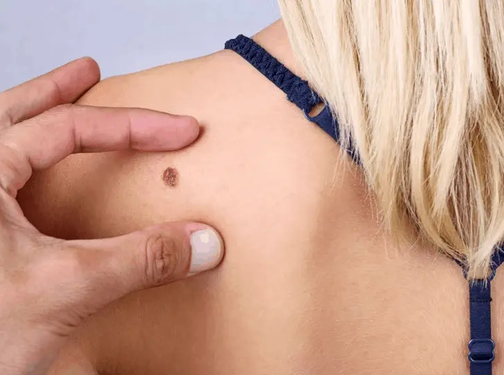woman having mole removal Sutton in Ashfield consultation before treatment.