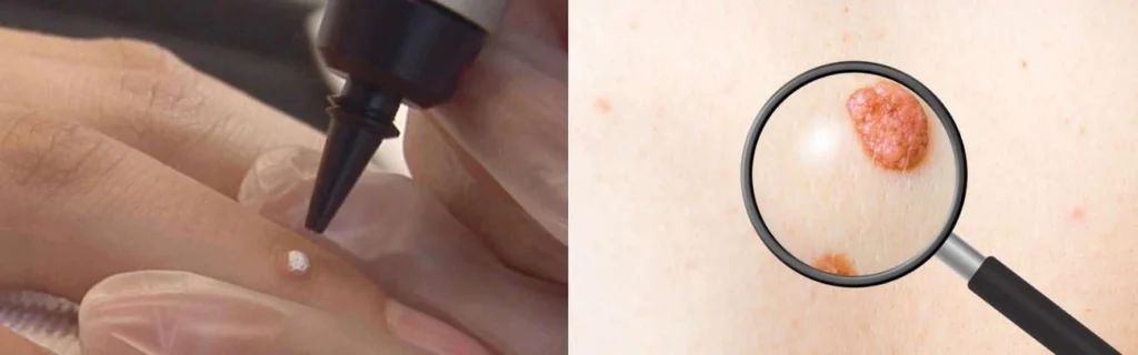 CryoPen practitioner Sutton in Ashfield assessing a benign mole before treatment