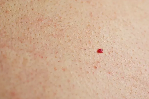 close up of a cherry angioma Sutton in Ashfield