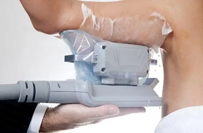 Picture of fat freezing Sutton in Ashfield on the upper arms.