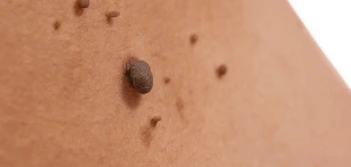 image of a skin tag Sutton in Ashfield