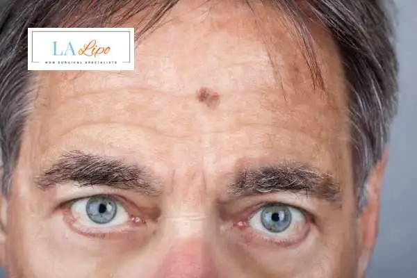 Solar Lentigo Removal Sutton in Ashfield image of man with mark on his forehead