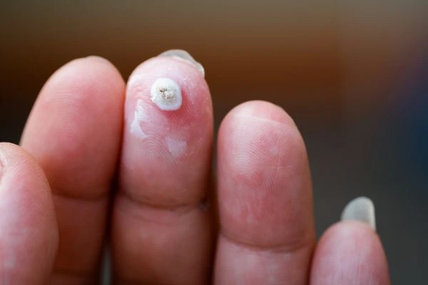 wart on person finger - cryotherapy to treat from LA LIPO Sutton in Ashfield