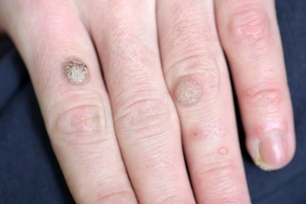 Common wart on a patient's hand before CryoPen treatment