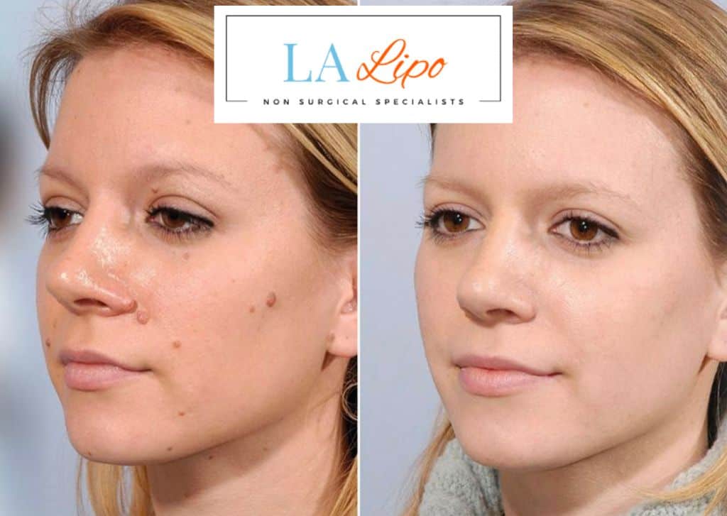 After Skin Tag Removal