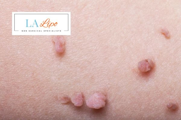 Does cryopen skin tag removal Sutton in Ashfield hurt? Find out now call our team today!