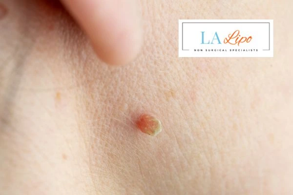 Book skin tag removal Sutton in Ashfield today speak to our team now!