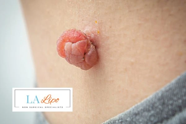 Interested in skin tag removal Sutton in Ashfield? Concerned about the pain? Find out more today!