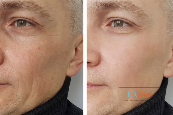 See the amazing results of Morpheus8 Treatment Sutton in Ashfield!