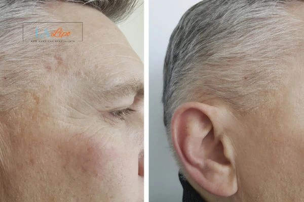 Mens Before & After Morpheus 8 Results Sutton in Ashfield
