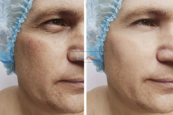 Before and after Morpheus 8 Results Sutton in Ashfield