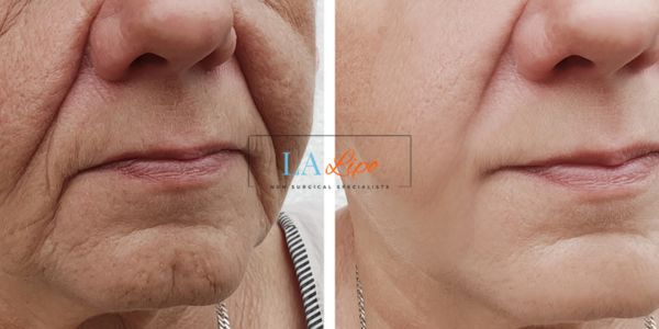 Older lady deeper wrinkle reduction - LA LIPO Morpheus 8 Results Sutton in Ashfield