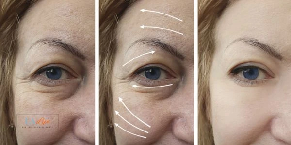 Amazing eye lift Morpheus 8 results Sutton in Ashfield