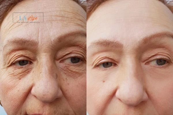 The powerful benefits of Morpheus8 Treatment Sutton in Ashfield - Call Our team today!