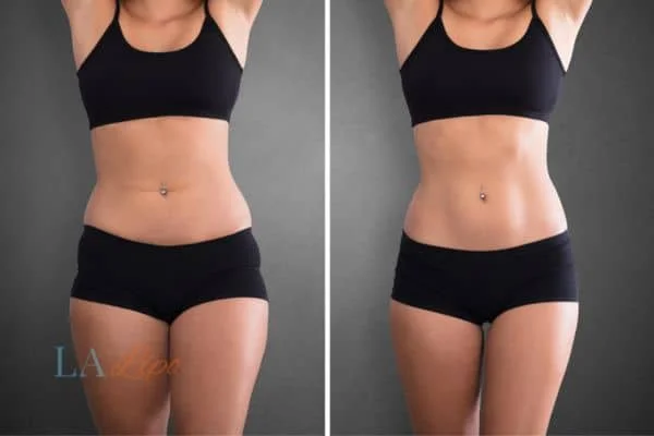 before and after results of non-surgical treatment to help a woman's body image and mental health Sutton in Ashfield