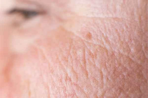 close up picture of a woman's face showing an age spot Sutton in Ashfield