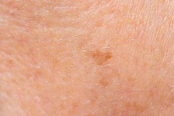 close up picture of age spots Sutton in Ashfield