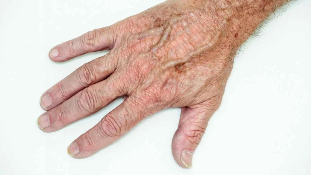Male hand showing age spot Sutton in Ashfield
