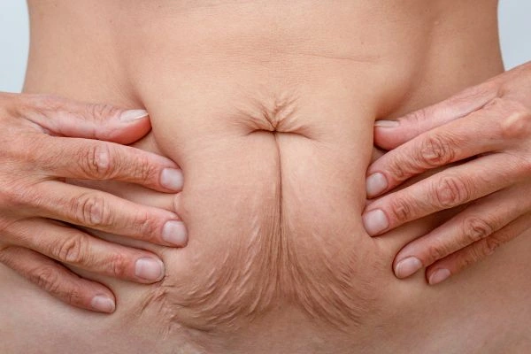 Image of a woman's stomach with loose skin - example of skin tightening Sutton in Ashfield options
