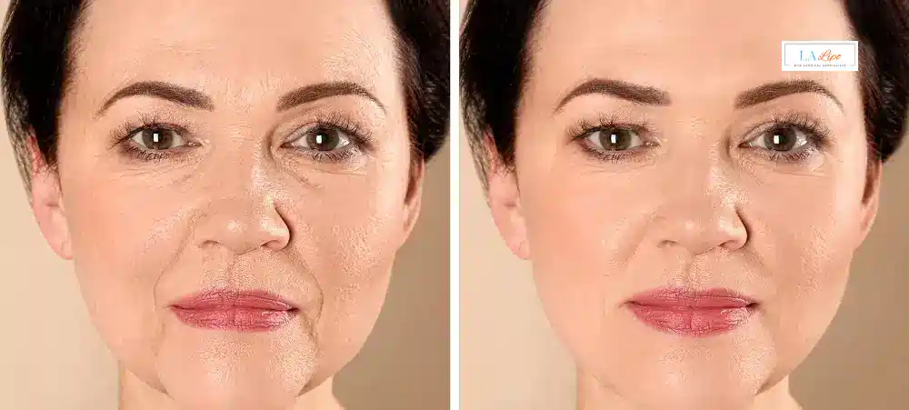 How Long Does It Take to See Results and How Long Do They Last Sutton in Ashfield?