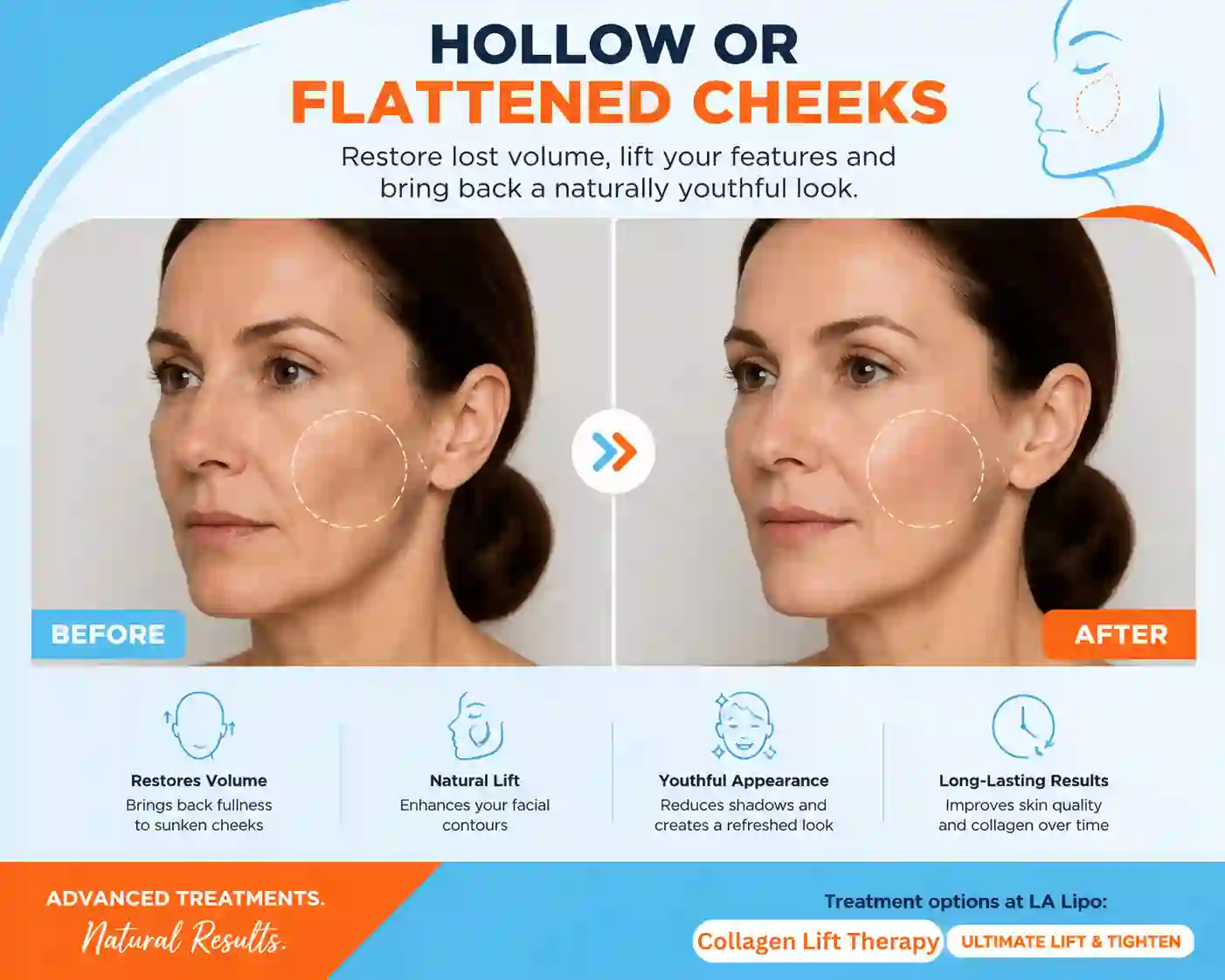 Sign #4: Hollow or Flattened Cheeks Sutton in Ashfield